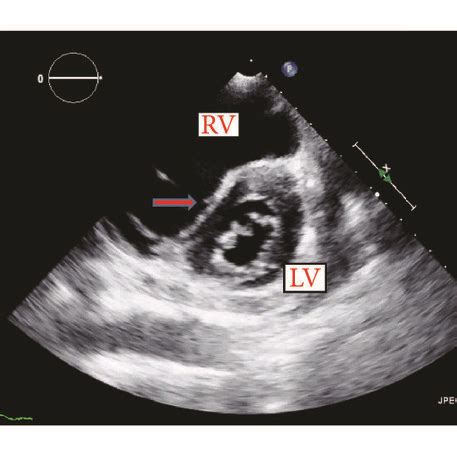 d shaped left ventricle function.